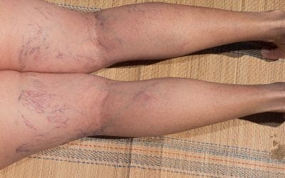 Occupations Most at Risk for Varicose Veins – How to Help