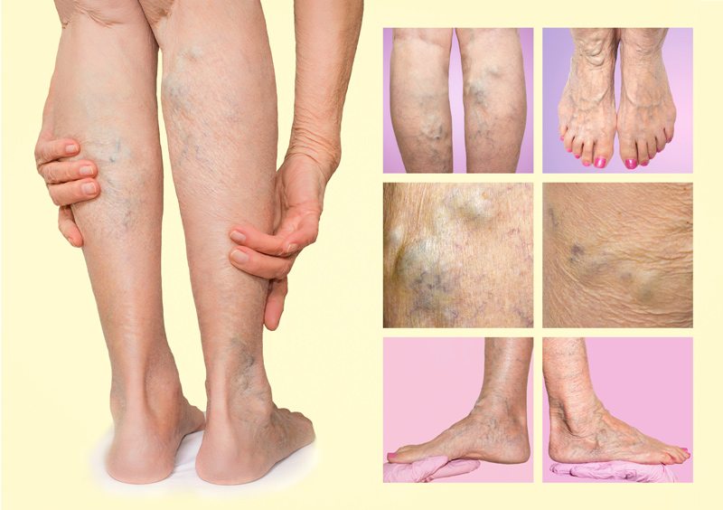 Pictures of varicose veins in legs and feet