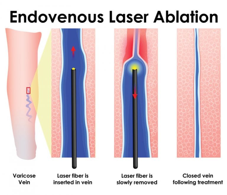compression stockings Archives Page 2 of 2 The New Jersey Vein