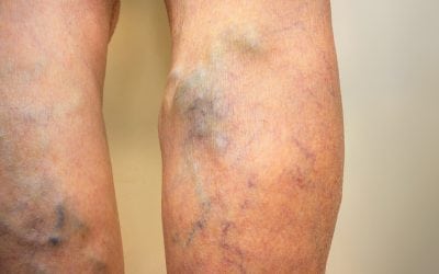 Venous Insufficiency and When to See a Vascular Specialist