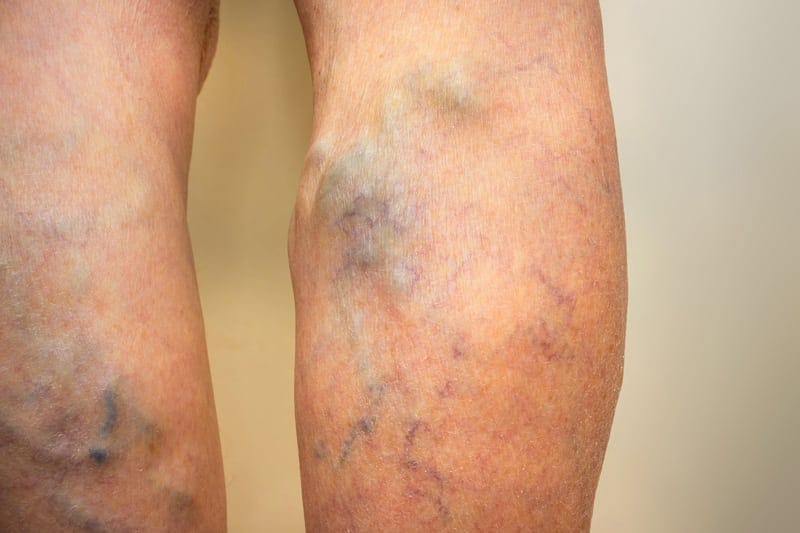 venous-insufficiency-and-when-to-see-a-vascular-specialist-njvvc