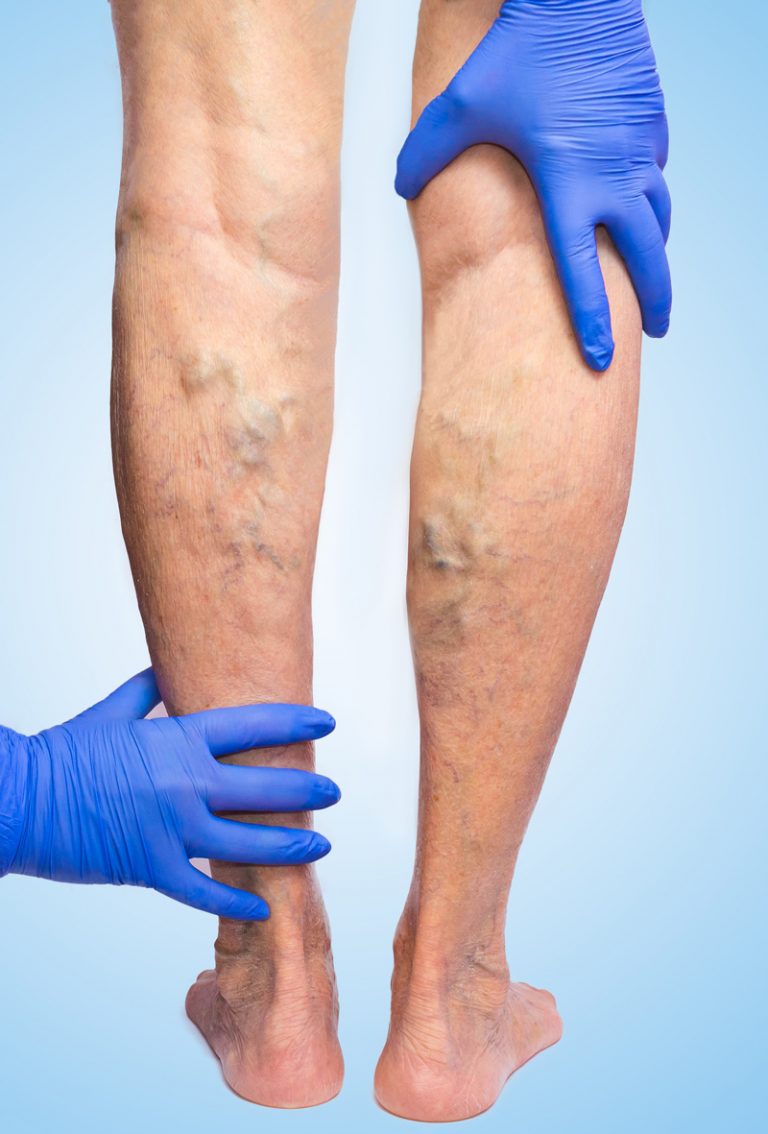 Venous Insufficiency And When To See A Vascular Specialist Njvvc