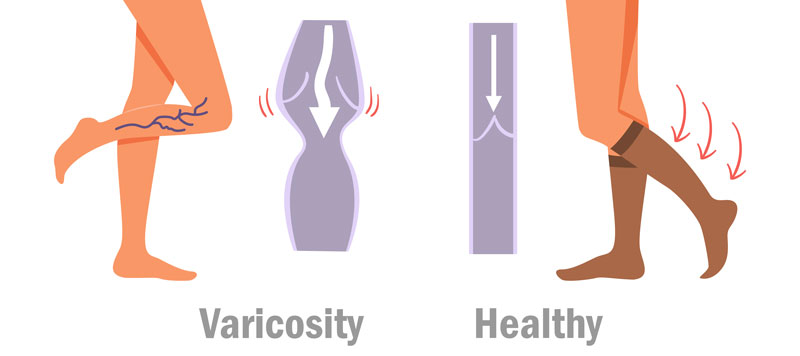 How Do Compression Stockings Work 