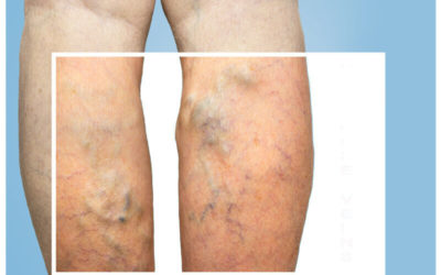 Cause and Prevention of Common Vein Conditions