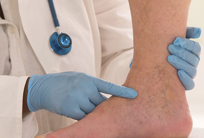 Vein Treatment