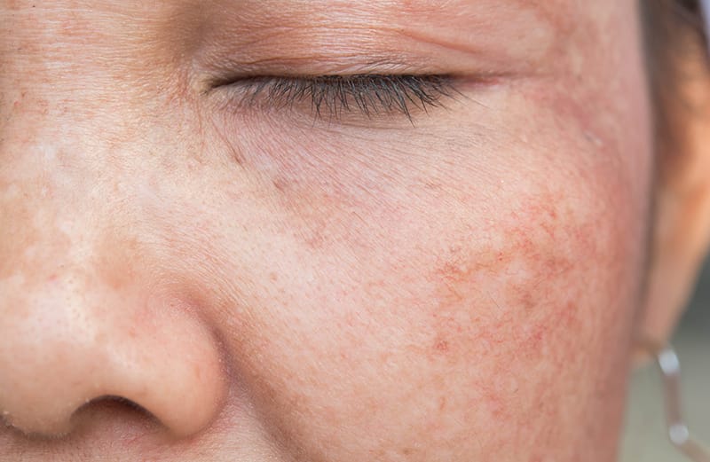 Hyperpigmentation on Face