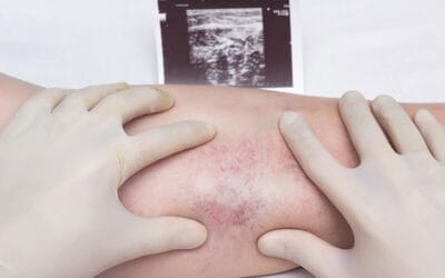 Understanding and Preventing Leg Blood Clots (DVT)