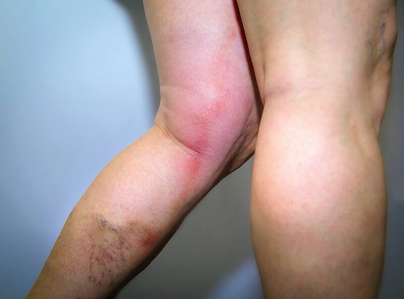 Leg-with-DVT-and-Varicose-Veins