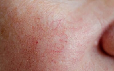 Spider Veins on Your Face: Causes and Treatment