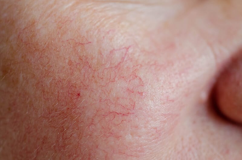 Spider Veins on Your Face: Causes and Treatment - The New Jersey Vein & Vascular Center