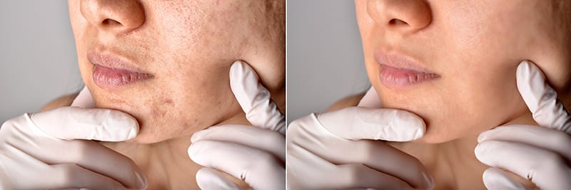 chemical-peels-for-acne-scars-the-new-jersey-vein-vascular-center