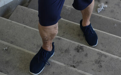 Varicose Veins in Men—What You Should Know