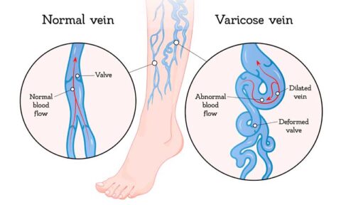 How Exercise Promotes Healthy Veins - The New Jersey Vein & Vascular Center