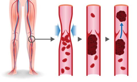 Everything About CVI Explained - The New Jersey Vein & Vascular Center