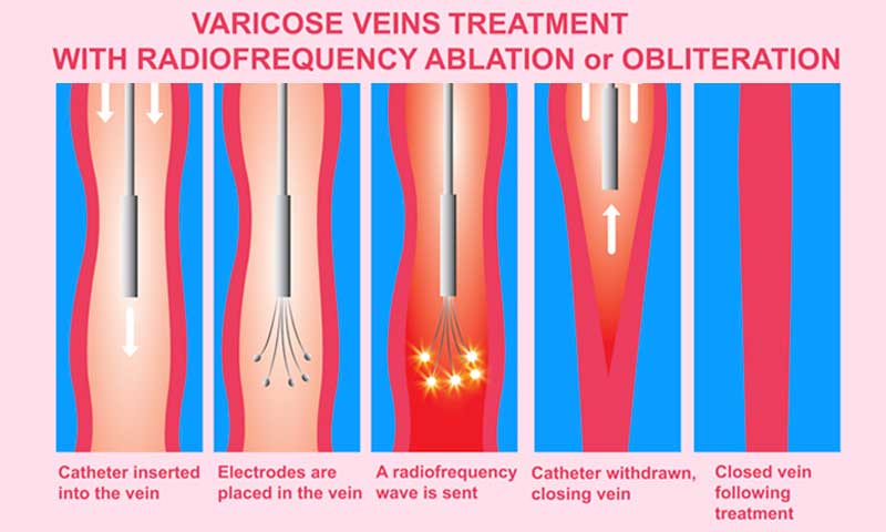 endovenous-ablation, varicose veins and treatment with ablation