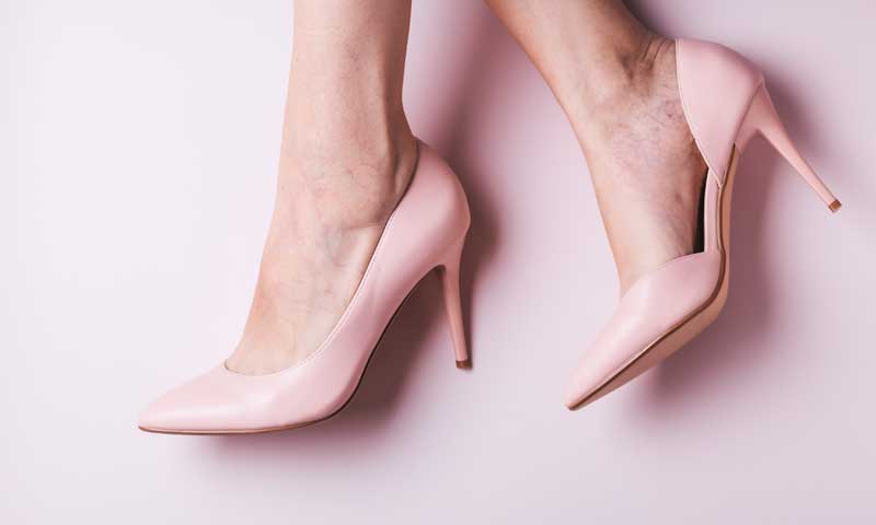 Close-up of woman’s feet with spider veins in pink high heels