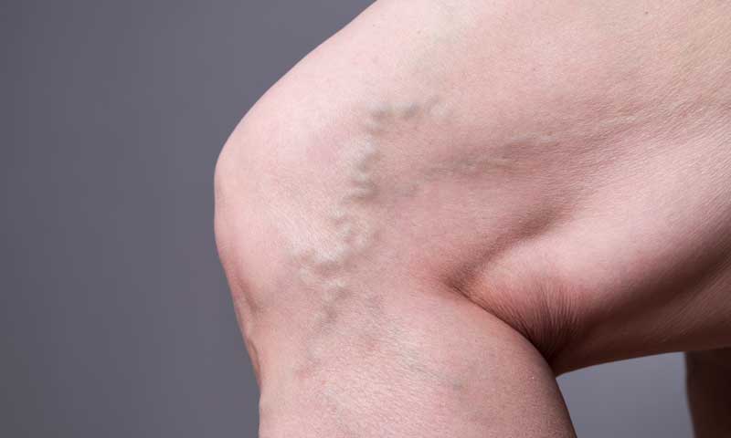 Varicose veins can cause feelings of leg heaviness and pain 