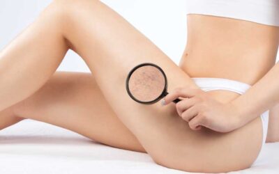 Can Spider Veins Come Back After Treatment?