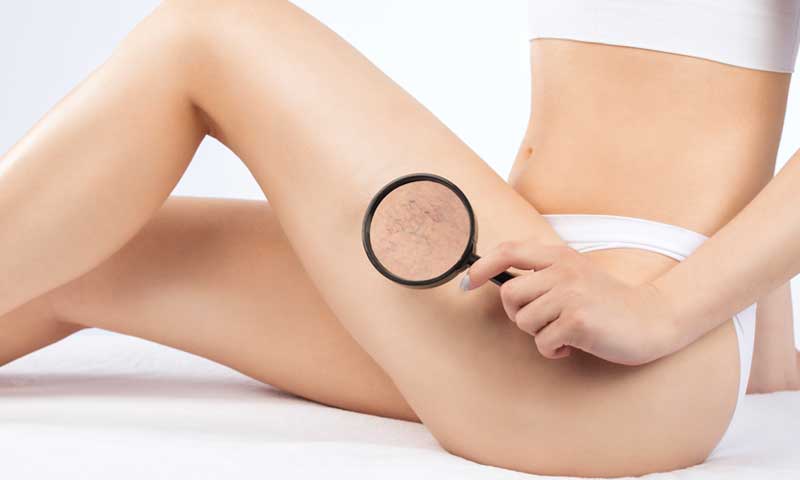 Can Spider Veins Come Back After Treatment?