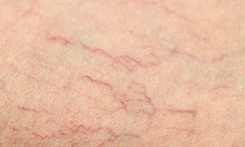A close-up of spider veins on the skin