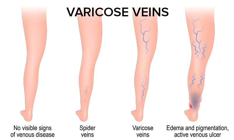 Graphic showing legs in various stages of venous disease
