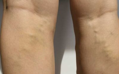 Diet and Varicose Veins – What’s the Connection?