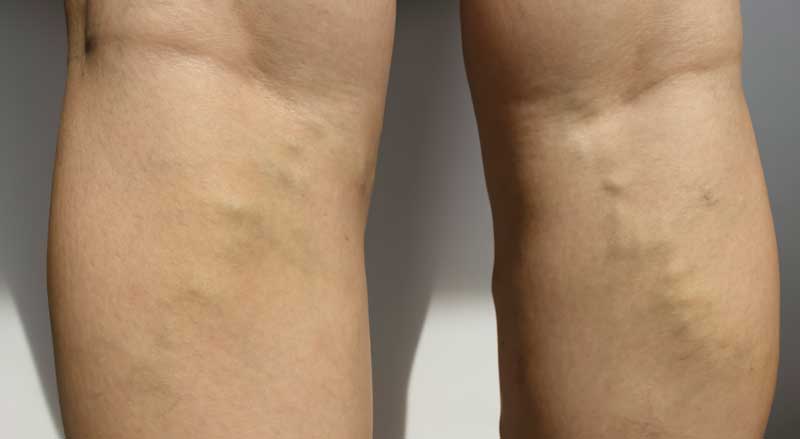 6 Things to Know About Varicose Veins