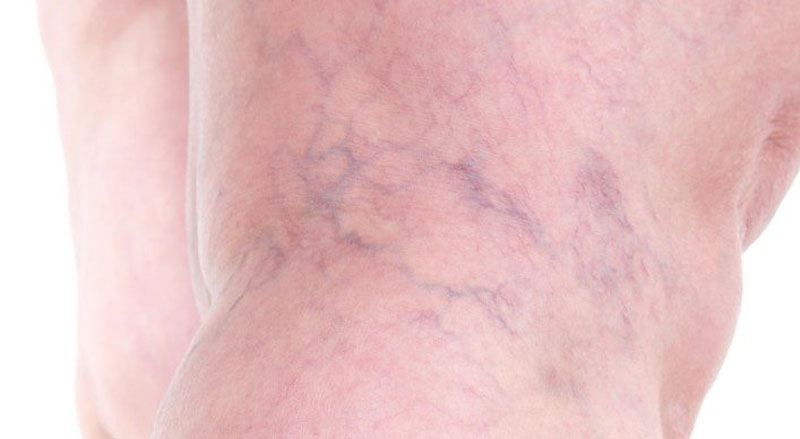 Reticular veins on the back of a leg