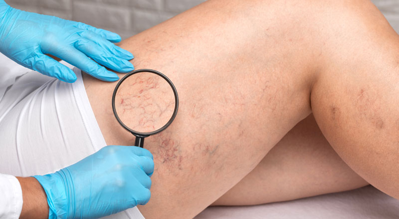 Doctor using a magnifying glass to look at spider veins on a person’s legs