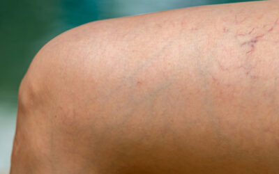 Spider Veins vs. Reticular Veins … what’s the Difference?