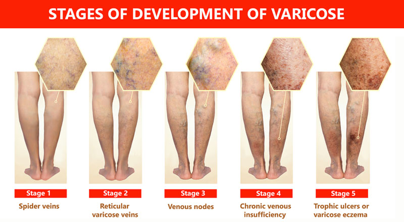 Stages of the development of varicose veins