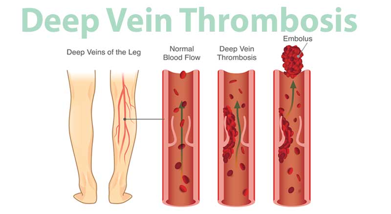 An infographic displaying danger of Deep Vein Thrombosis (DVT).