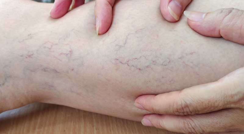 A woman looks at the veins on her legs