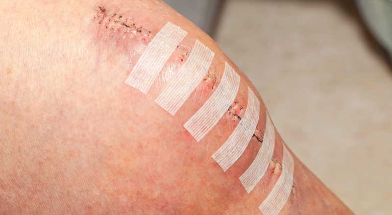 A person’s knee after knee surgery with stitches and bandages on it