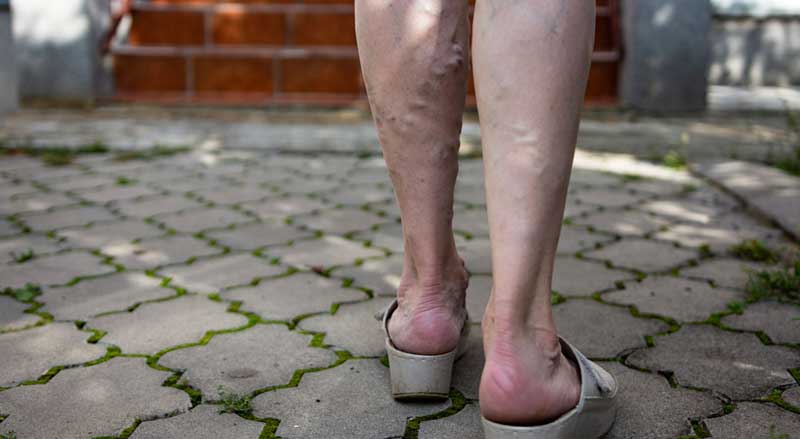 Close-up of woman’s legs with varicose veins on path