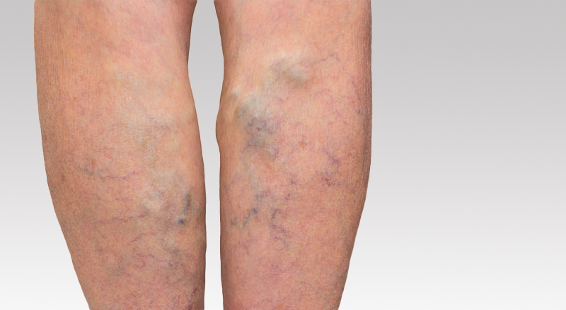 A close-up of legs with varicose veins that require treatment.