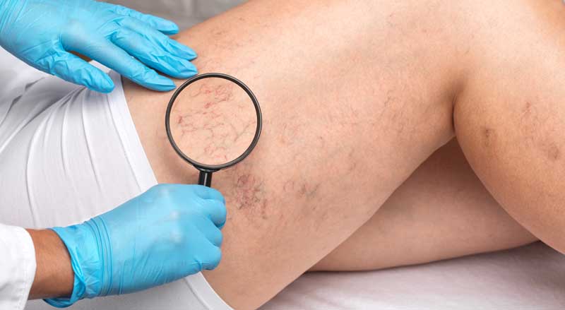 A vein doctor examines spider veins on a leg to determine if sclerotherapy is needed