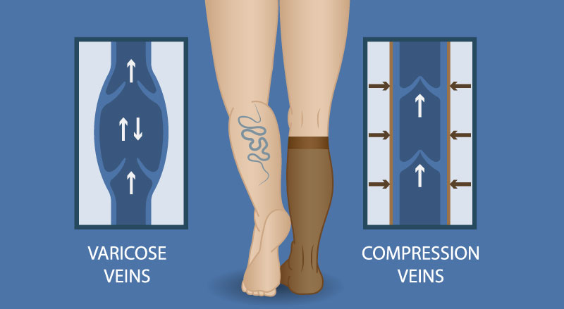 An infographic showing how compression socks improve blood flow