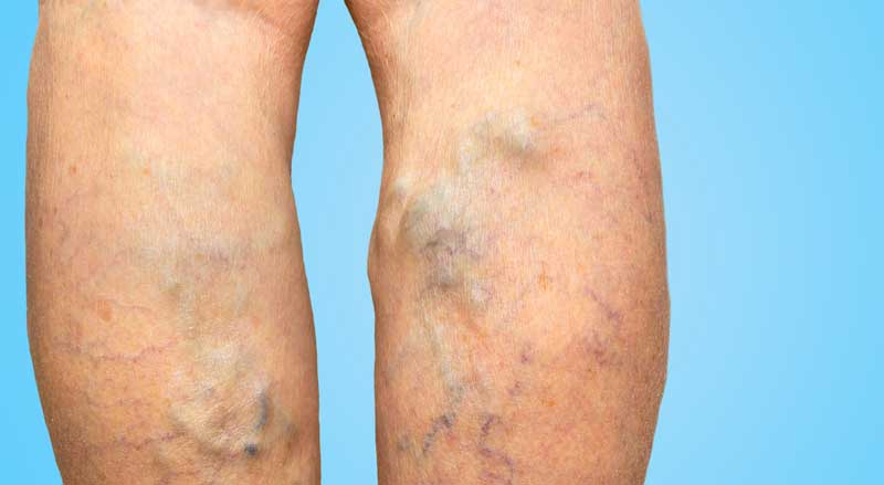 A closeup of a person’s legs with varicose veins
